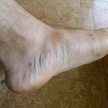 Mosquitos are jerks.